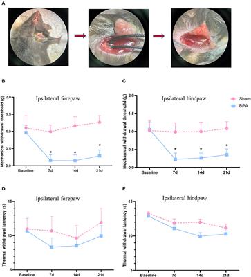 Brachial plexus avulsion induced changes in gut microbiota promotes pain related anxiety-like behavior in mice